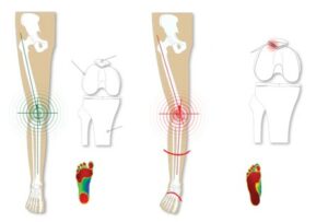 Animated diagram demonstrating how over-pronation causes stress on our knees. 