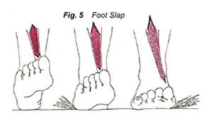 Shin Splints Foot Slap
